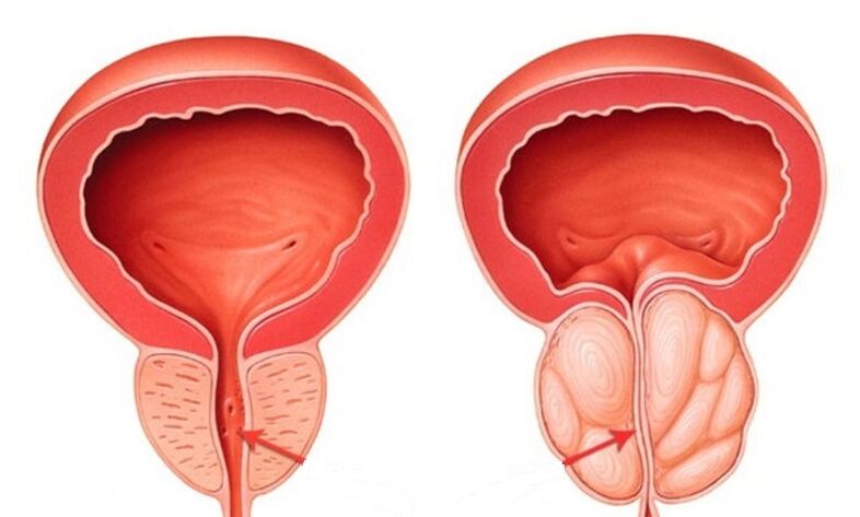 Zdrava i upaljena prostata prostatitisom