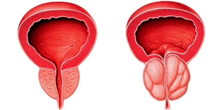 Normalna i upaljena prostata