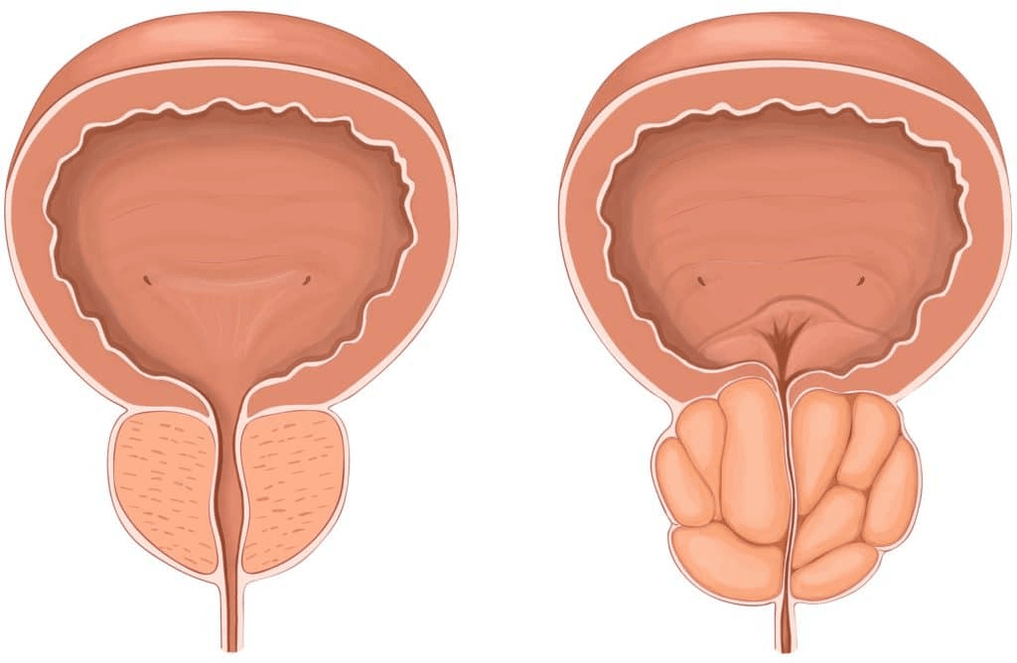 Što se događa s prostatom tijekom prostatitisa